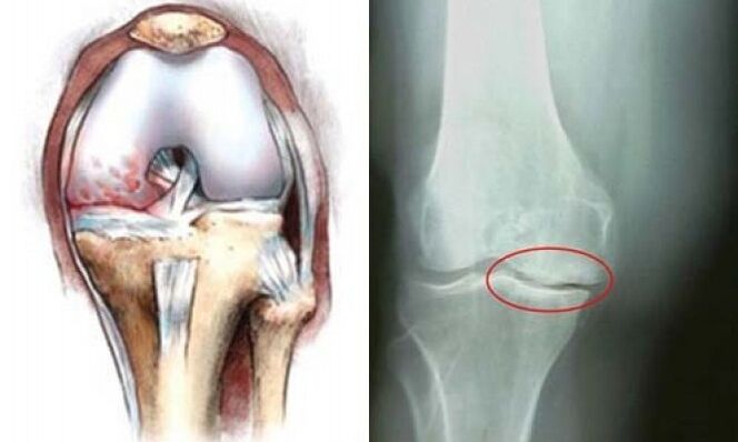 knee x-ray arthrosis
