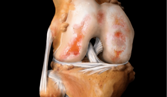 osteoarthritis of the knee joint