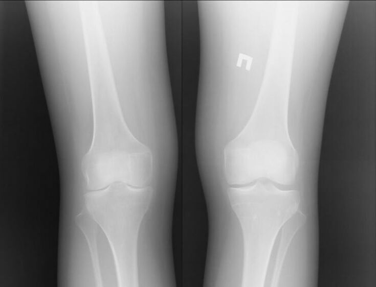 X-ray of knees affected by osteoarthritis