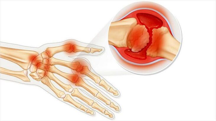damage to the joints of the hand due to arthritis