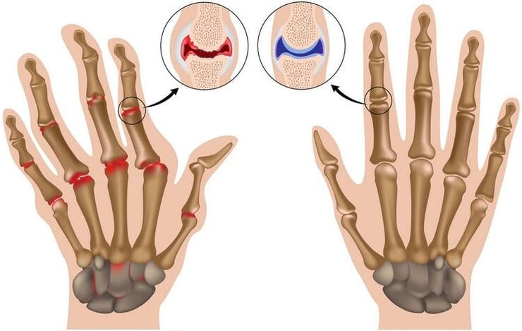 healthy joints of the hands and joints damaged by arthrosis