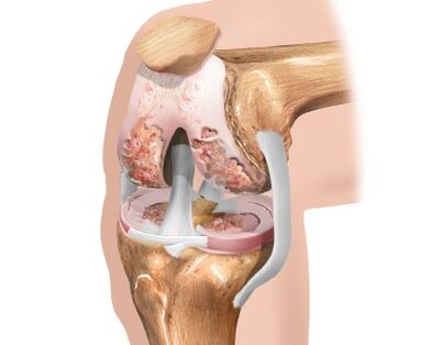 destruction of the knee joint due to arthrosis